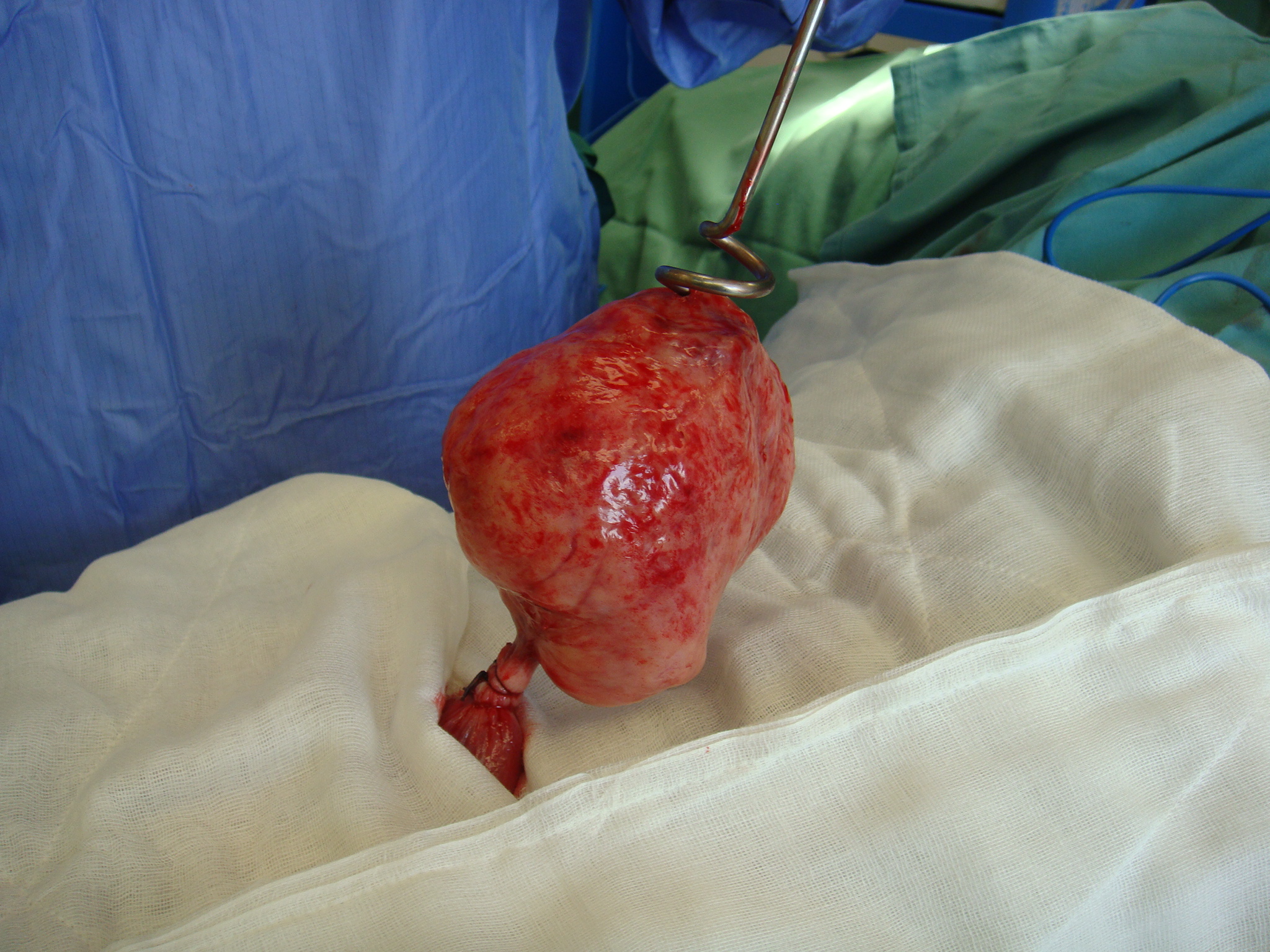 myomectomy pedunculated fibroid Serag Yousssif